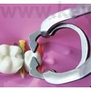 Picture 2/2 -Divided metal adhesive clamping ring, 1 piece, with 1 projection, standard,, wedge-shaped