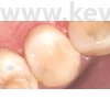 Picture 10/13 -Metal subdivided sticker, 50 pieces/box, molar , thickness: 0.038 mm - in various designs