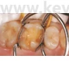 Picture 12/13 -Metal subdivided sticker, 50 pieces/box, molar , thickness: 0.038 mm - in various designs